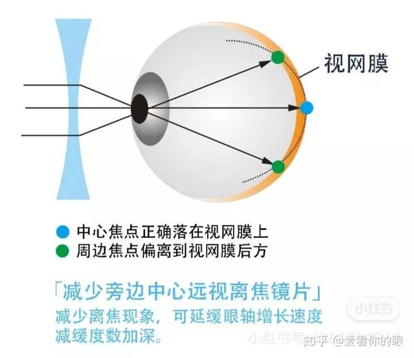 离焦眼镜
