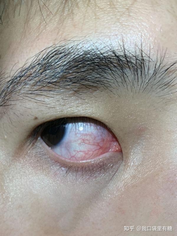 眼睛为什么红