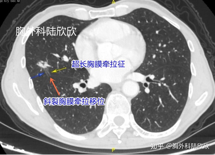 一个有细长腿的混合磨玻璃结节