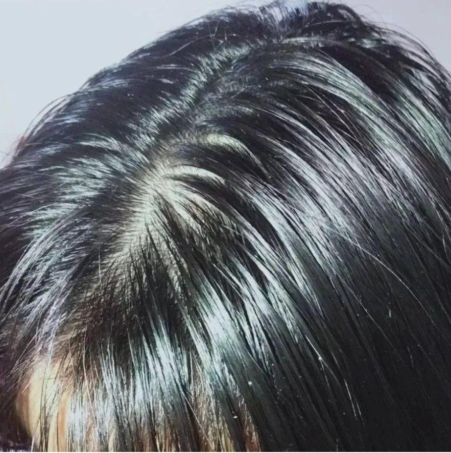 多油缺水,需要头皮水油平衡