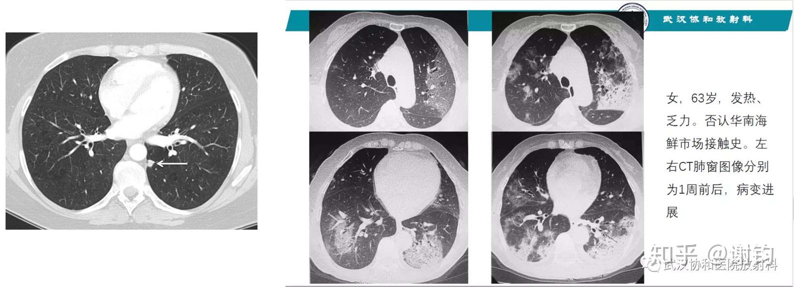 ARDS肺泡图片