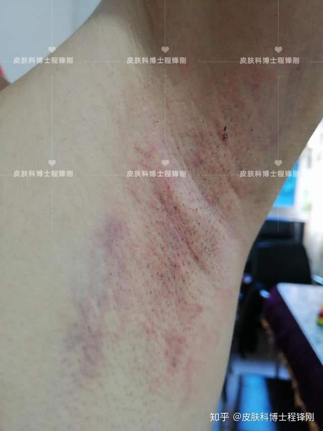 案例分享19岁男生遗传狐臭因为当兵前来治疗