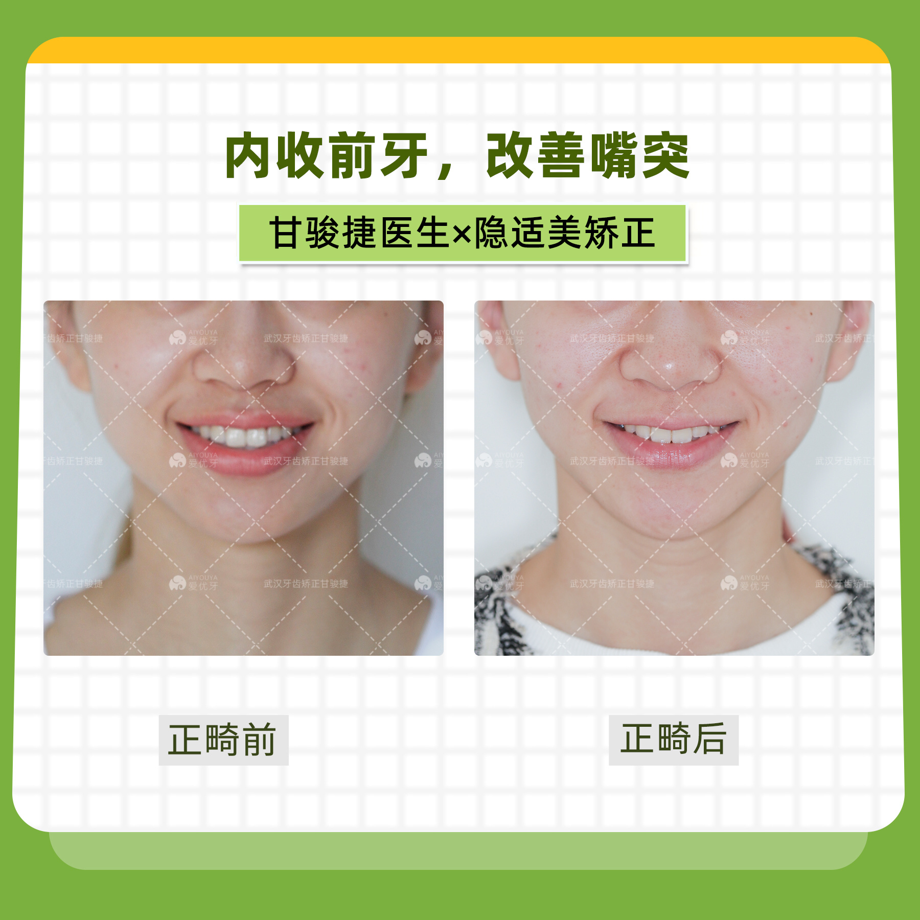 宁芳博士：未拔牙改善嘴凸，变身气质女孩！ （北京牙齿矫正案例） - 哔哩哔哩