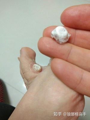 长了鸡眼怎么办怎么去除