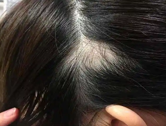 四十几岁女人掉头发是什么原因?