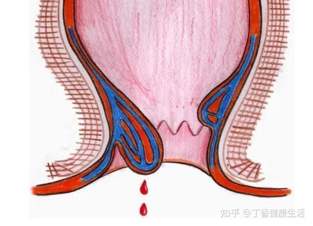 出血治愈图片