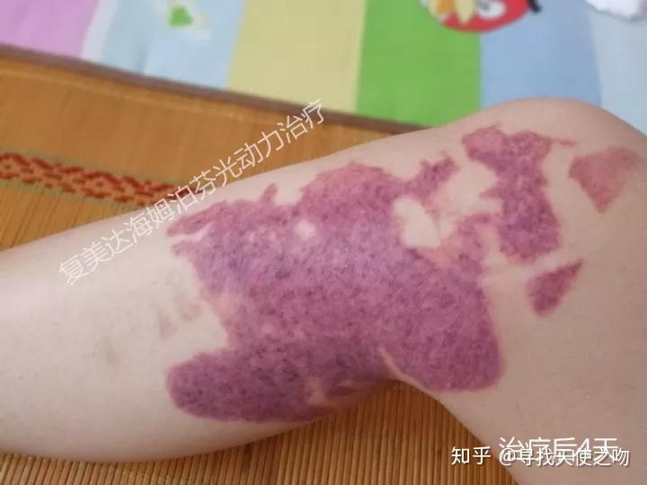 摆脱红胎记的时候我将穿上最美的裙子