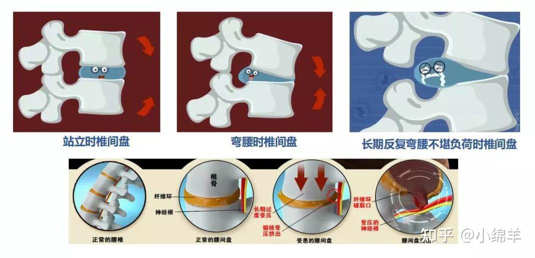 腰椎间盘突出能治好吗？教你一招，每天仅需10分钟 知乎