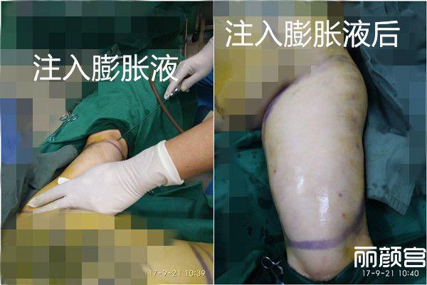 手臂吸脂,后背抽脂,颈椎处吸脂,丽颜宫图片展示手臂抽脂详细过程