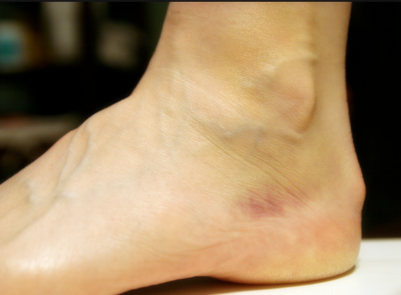 脚踝腓骨肌滑脱了怎么治疗啊