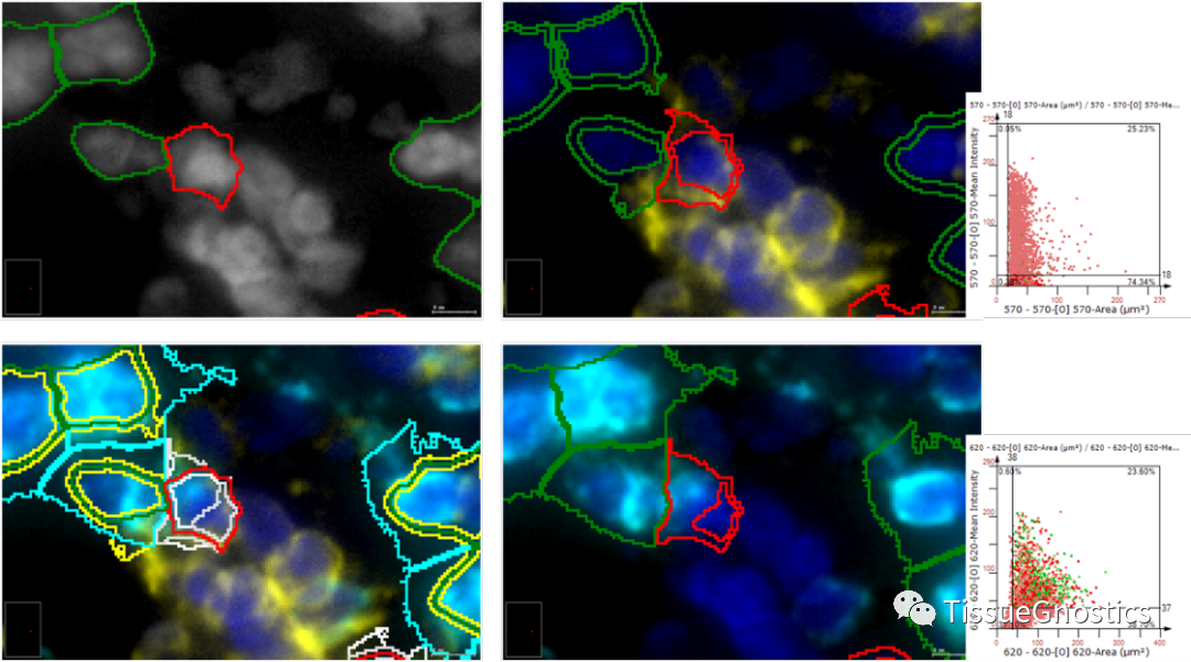 Hepatology|中山大学附属第一医院匡铭教授团队揭示肝细胞癌射频消融后复发潜在机制 - 知乎
