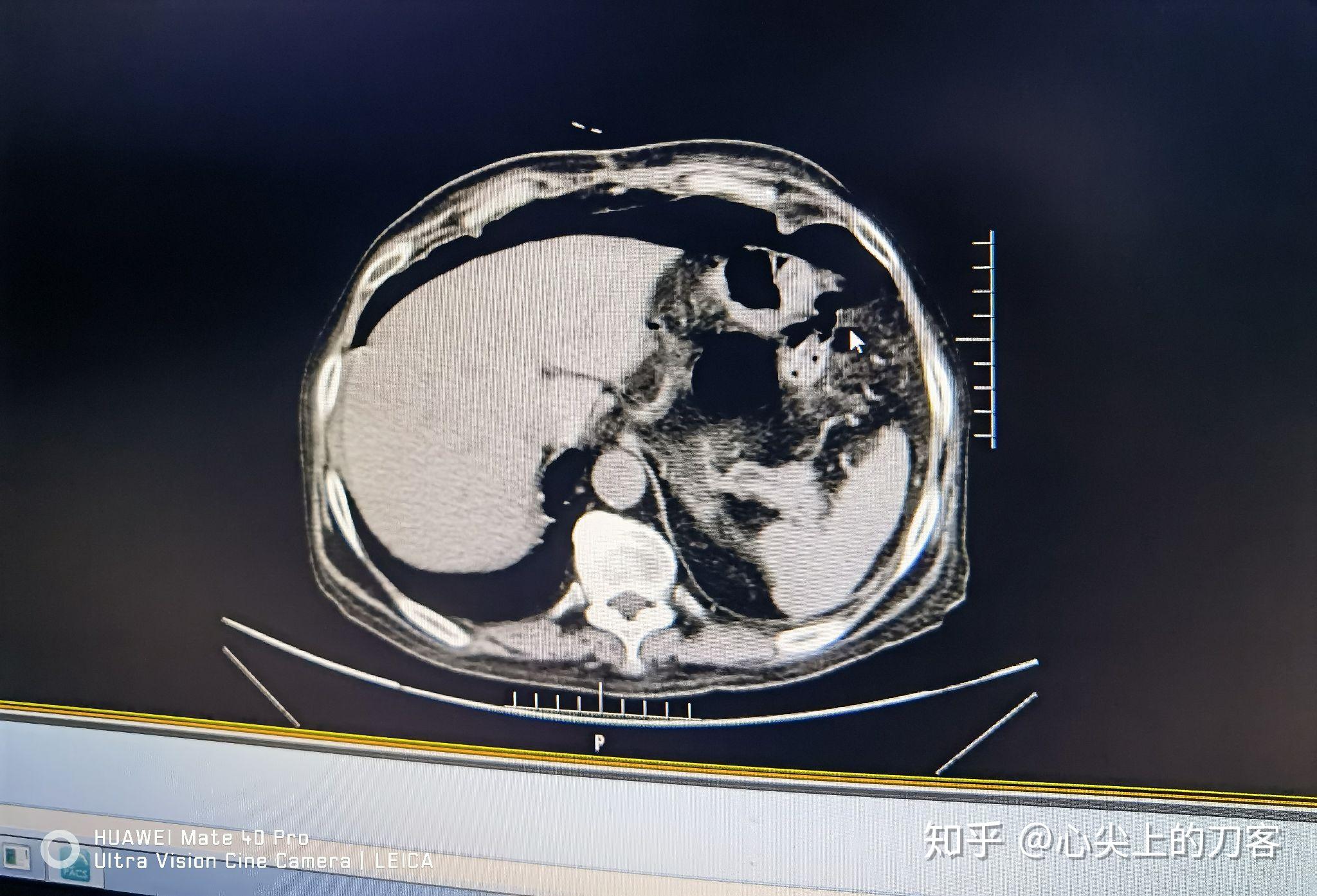 治疗期间出现腹痛难忍,行上腹部ct检查提示:胃窦部穿孔,急诊行胃穿孔