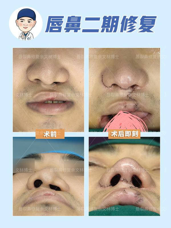 轻微兔唇会引起继发鼻畸形吗?唇裂鼻畸形要怎么修复? - 知乎