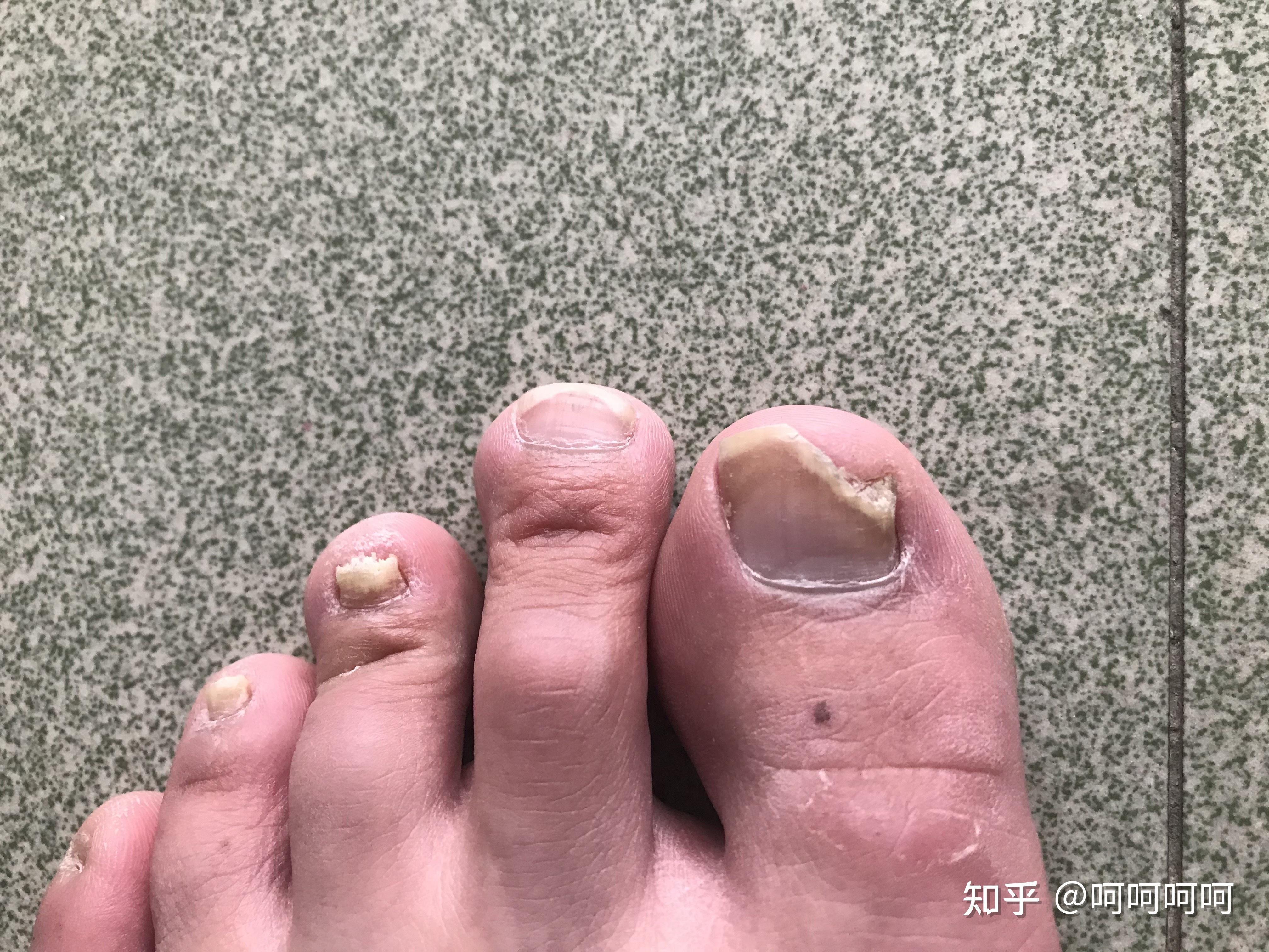 与灰指甲斗智斗勇的那些年!终于下定决定要根治它! - 知乎