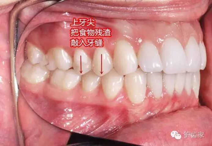 一 充填式牙尖垂直型嵌塞大致分为以下几个方面:61垂直型塞牙:咀嚼