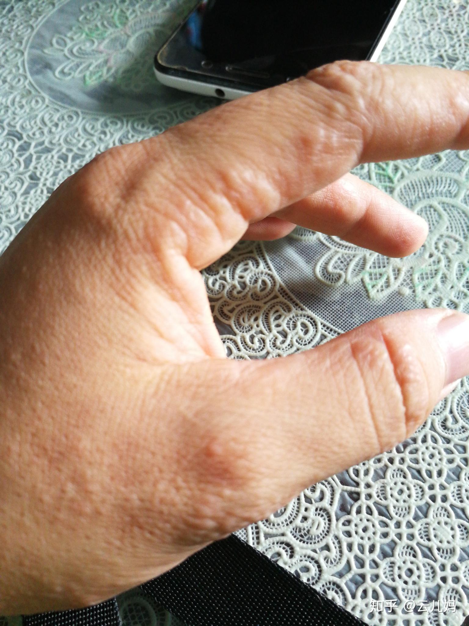 手上长了很多湿疹怎么办?