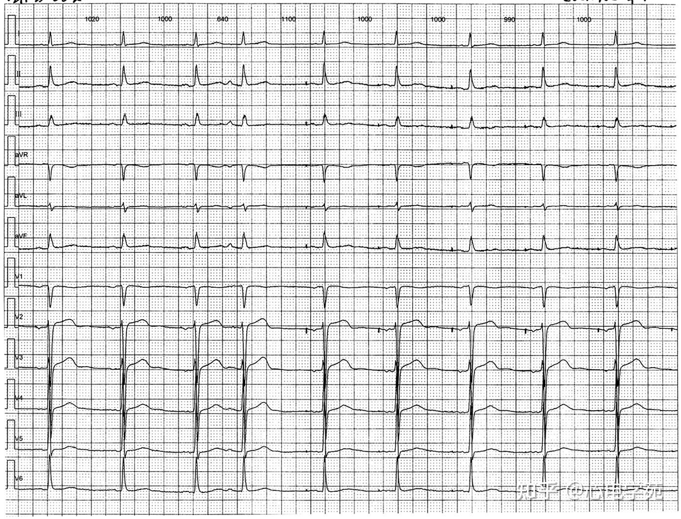 早搏引发心房起搏心律