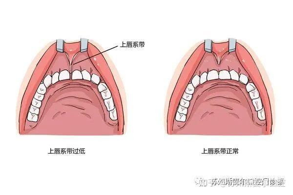 乳唇系带附着于上排中间两颗门牙之间的外侧牙龈和牙槽粘膜之间,如果