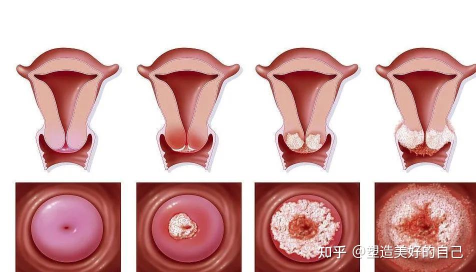 宫颈糜烂依据其病变深浅程度分为三型:炎症早期:糜烂面仅表现为单层柱