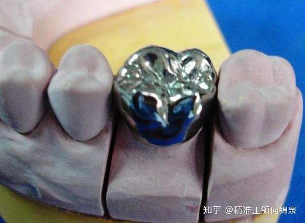根管治疗后要带"套"?是医生的套路吗?