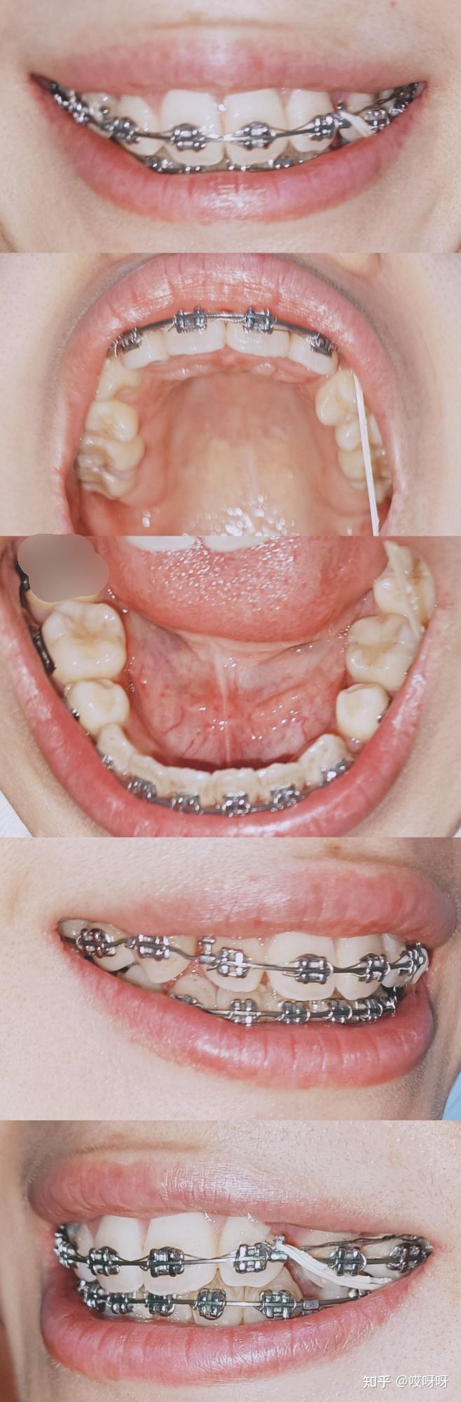 正畸分享|虎牙埋伏牙 - 知乎