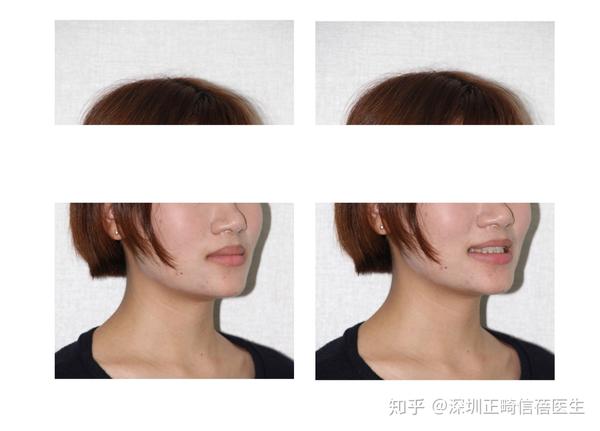 深圳牙齿矫正牙齿不齐拥挤案例