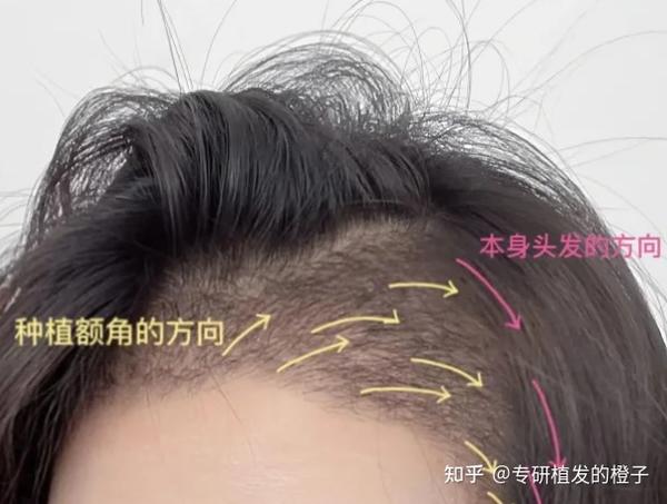 超8000字植发攻略奉上！植发技术如何选？植发好医生的评判标准是什么？植发手术风险后遗症？好的植发效果是什么样的？内附各地植发医生详细推荐名单！