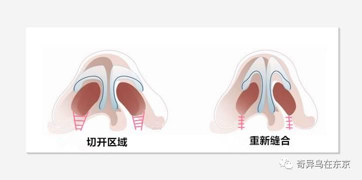 鼻翼缩小 | 如何get美人的鼻翼?