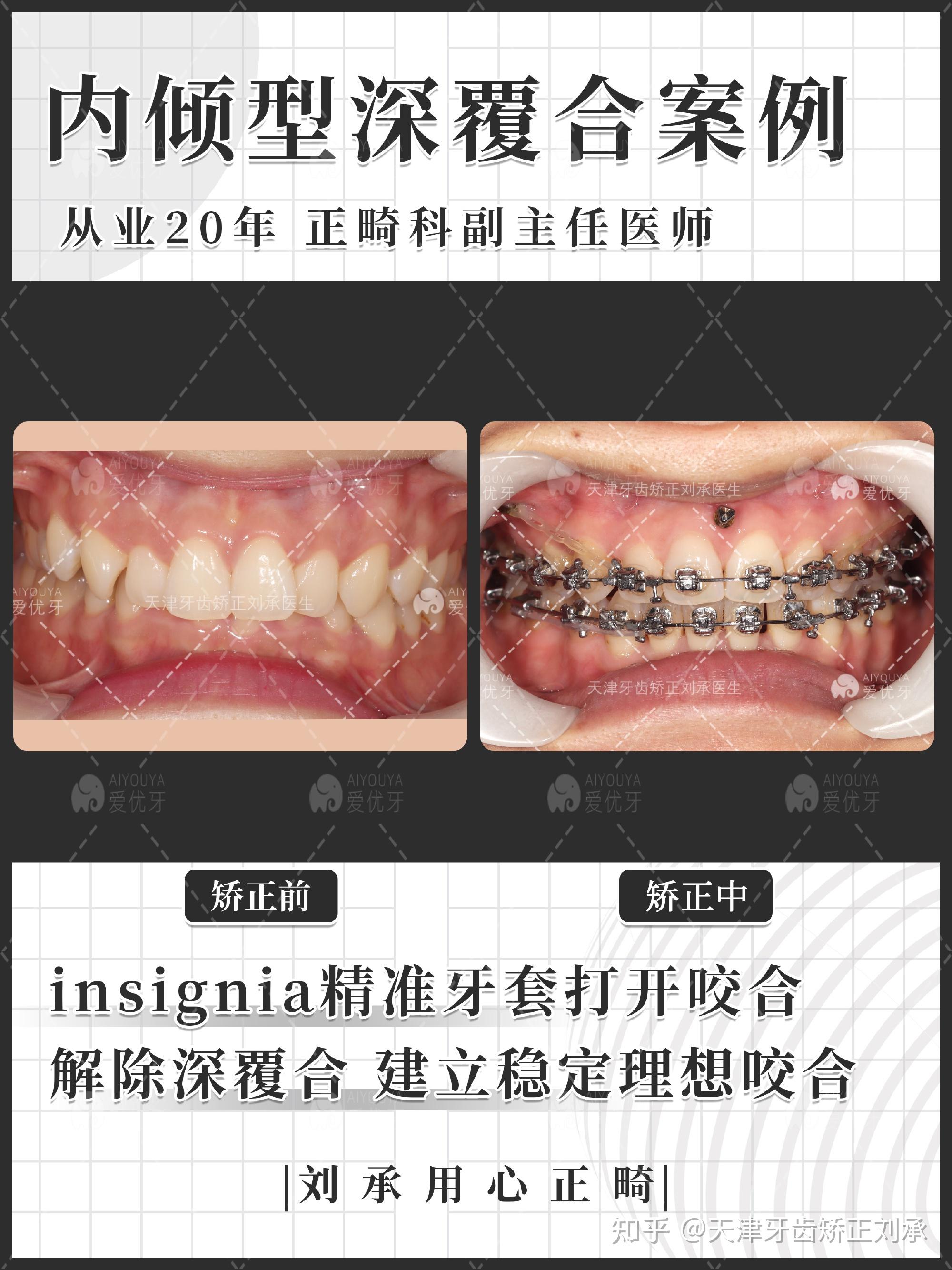 济南牙齿矫正丨济南整牙丨开唇露齿+牙周病丨牙周正畸联合治疗案例 - 知乎
