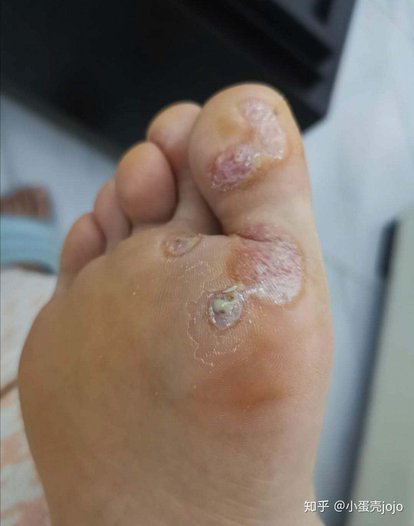 亲身经历浓碘酊和阿司匹林治好了跖疣两个月