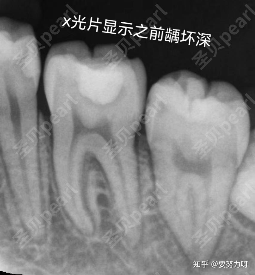 牙齿x光片龋齿图片