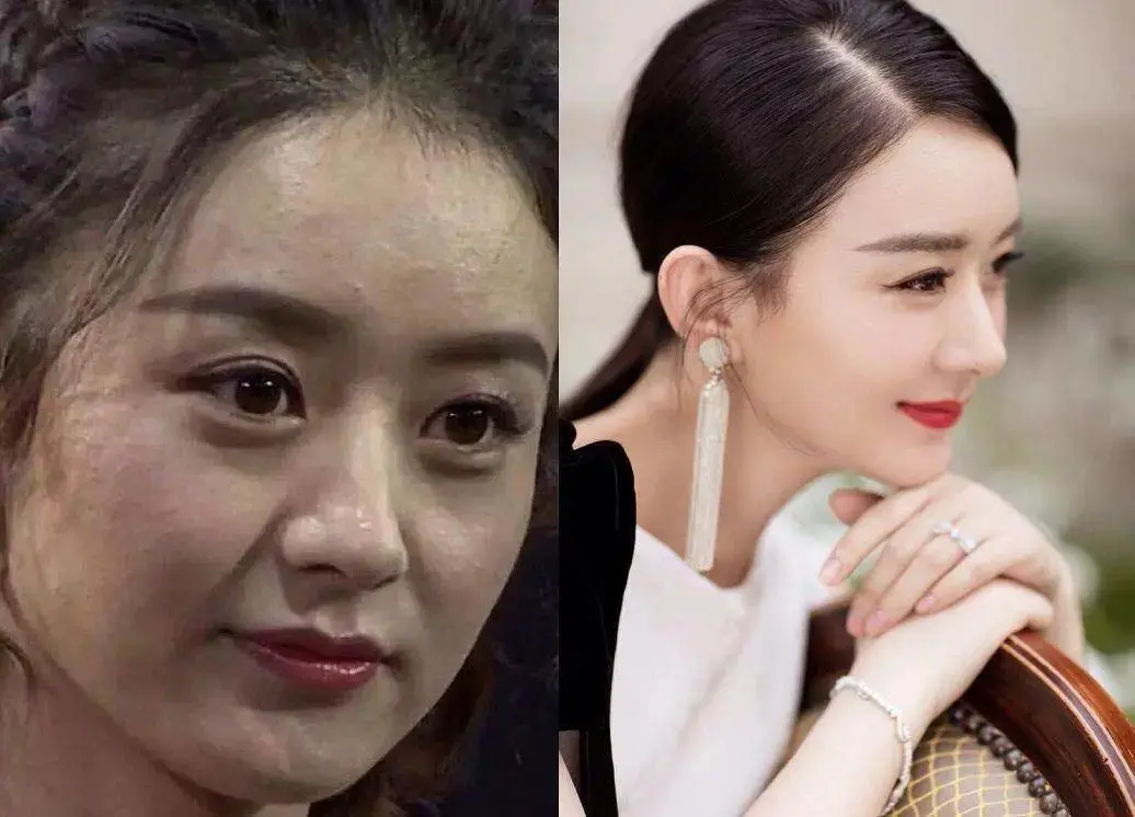 其实是"吃错药"的结果  ↓↓有段时间,赵丽颖满脸闭口粉刺就像32岁