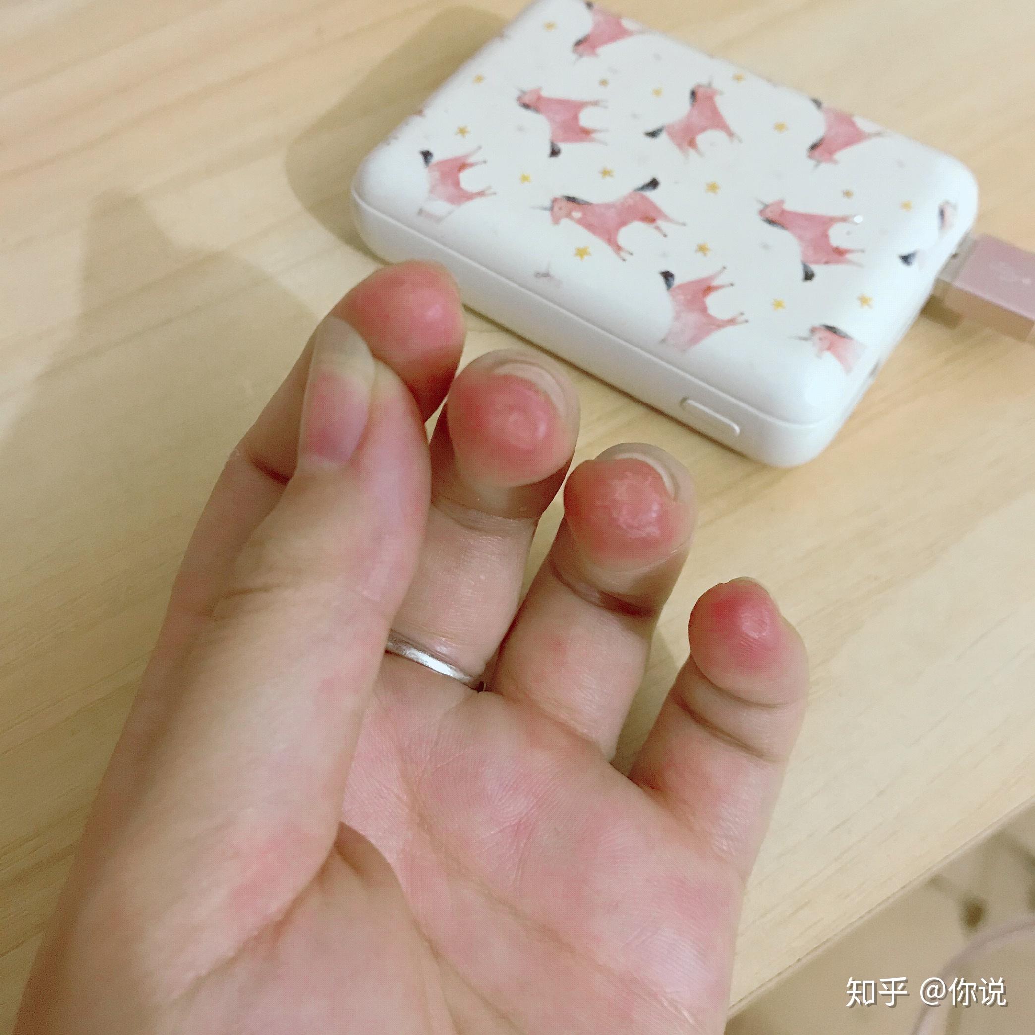 玩吉他的朋友可以拍一张左手手指上的茧吗