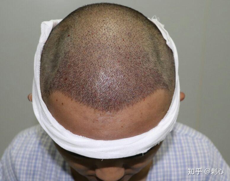 成都科发源微针植发4700单位