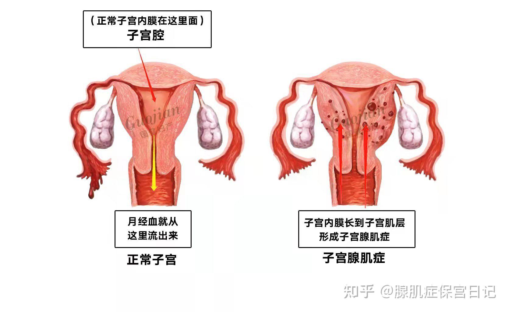 什么是子宫腺肌症