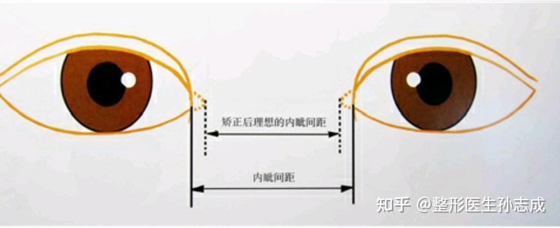 不同类型内眦赘皮的最全改善方法 - 知乎
