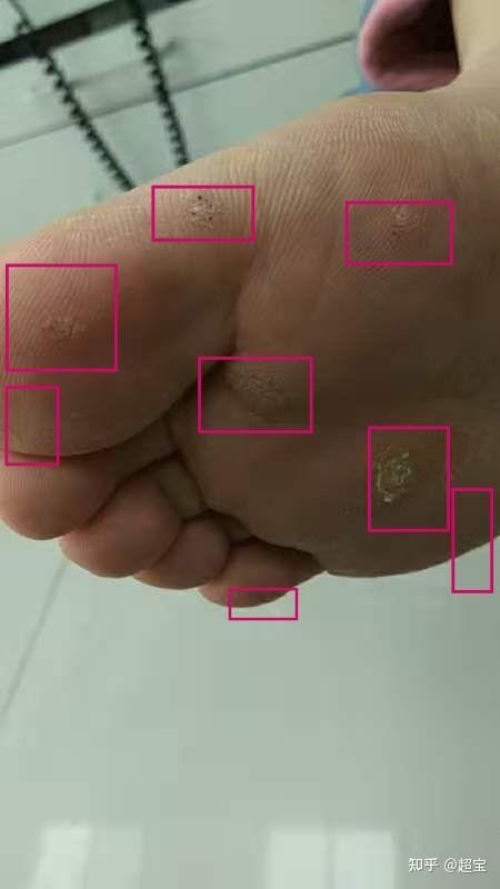 2020年过年疫情爆发,在家无事,突然发现长了这个东西,以为脚气之类的