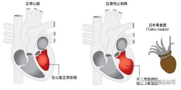 【医学科普】感觉心碎时有可能是真的心碎——压力性心肌炎与抑郁症 - 知乎