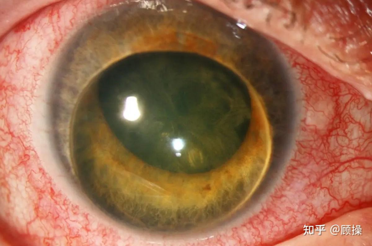 什么是晶状体脱位?