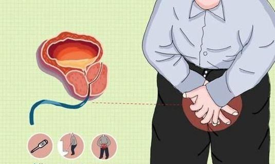1,前列腺增生中老年人常熟悉良性前列腺增生也有频繁排尿的症状