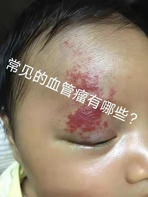 常见的血管瘤有哪些? - 知乎