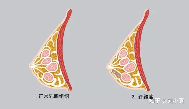 乳房硬块图片 结构图片