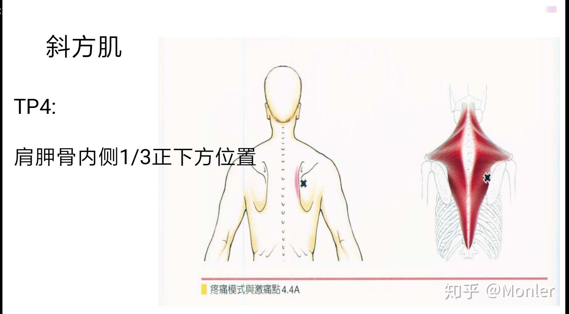 斜方肌常见的筋膜触发点