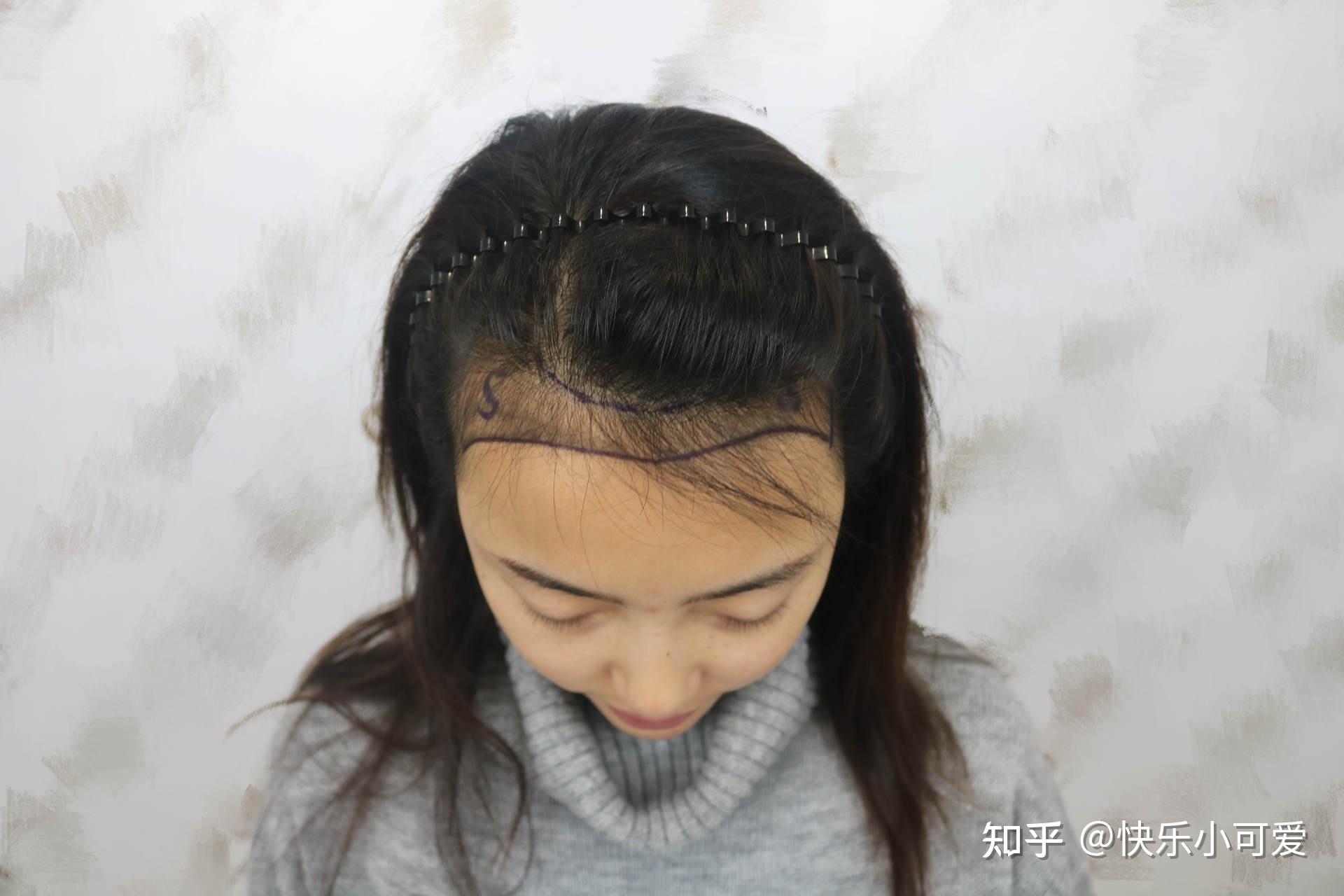 从秃头女贝勒到靓发美少女的蜕变拯救发际线实录