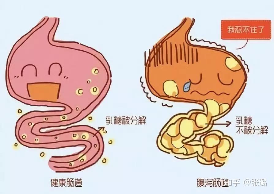 从临床医学上分类,腹泻可分为「渗透性」,「分泌性」和「渗出性」3种