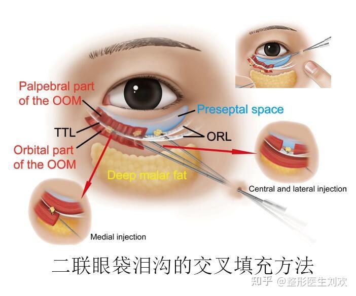 眼袋组织结构图图片