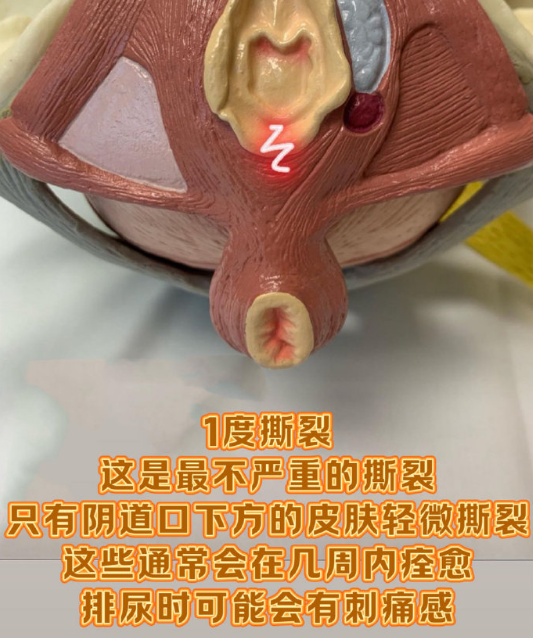 顺产阴道撕裂的四个等级 #十顺九裂