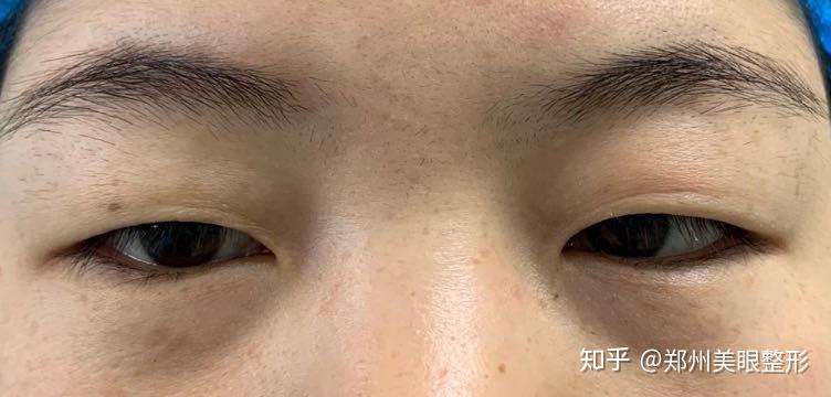 我这样的眼睛怎么整形感觉小眼睛不能割双眼皮阿