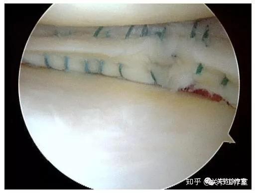 不適合前1/3的半月板損傷,神經血管損傷風險高全內縫合:柒半月板縫合
