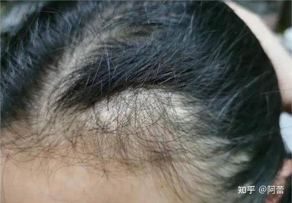 脱发的原因及解决方法